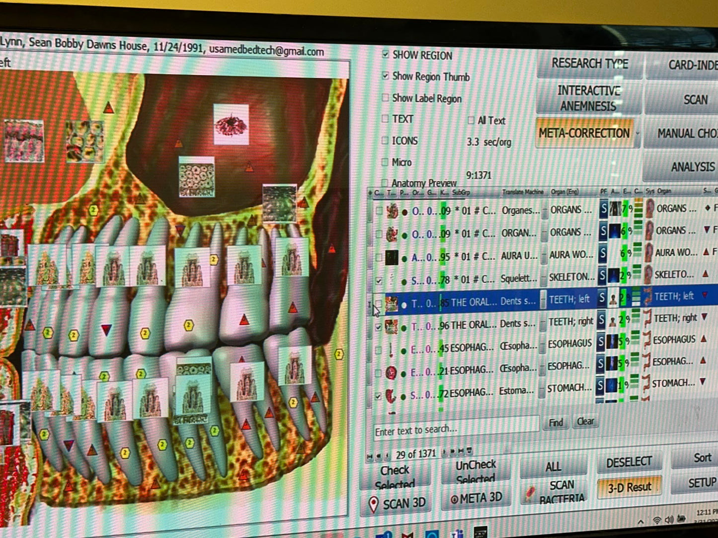 Computer screen displaying a dental model with digital labels and a software interface.