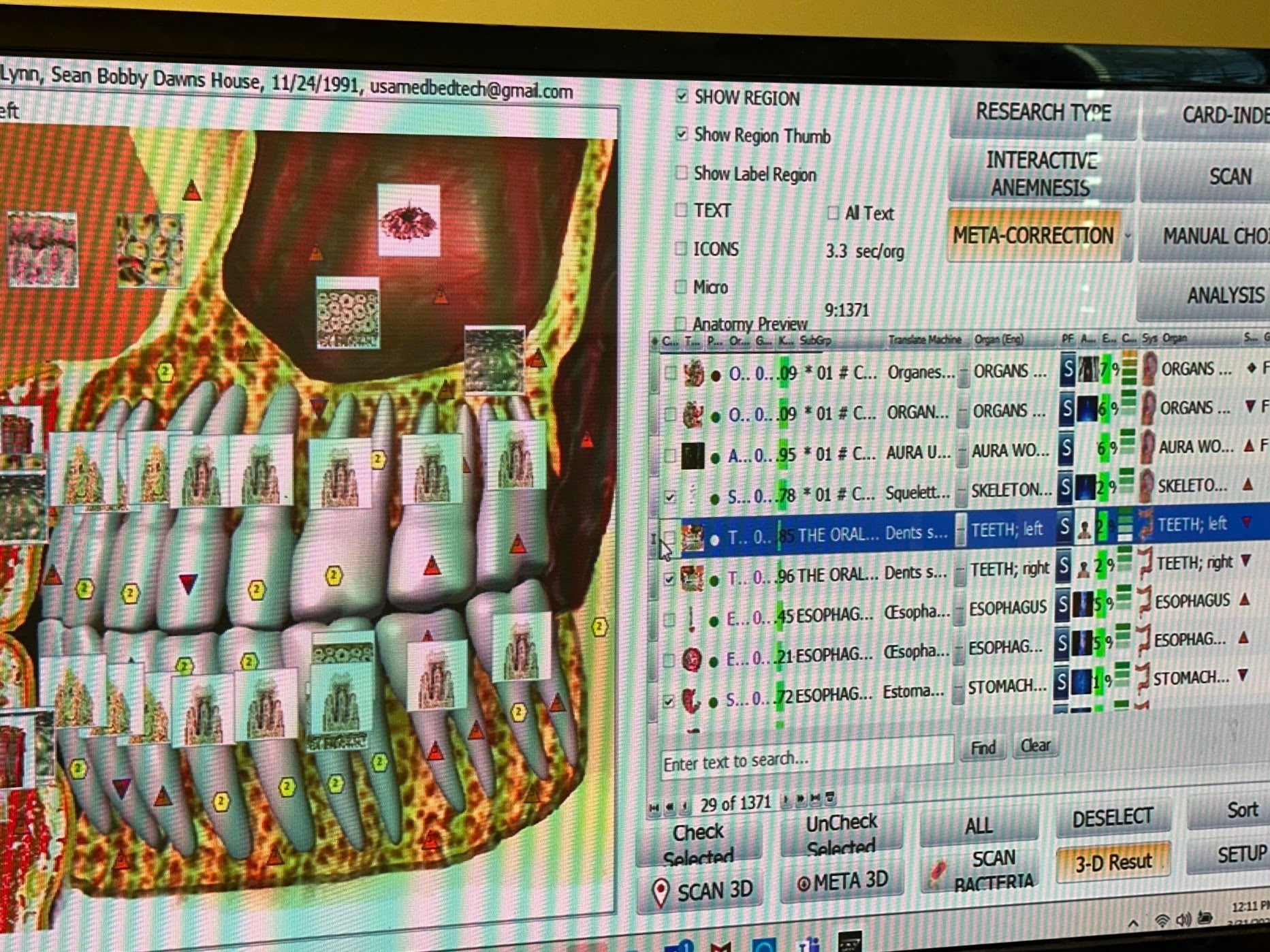 Computer screen displaying a dental model with digital labels and a software interface.