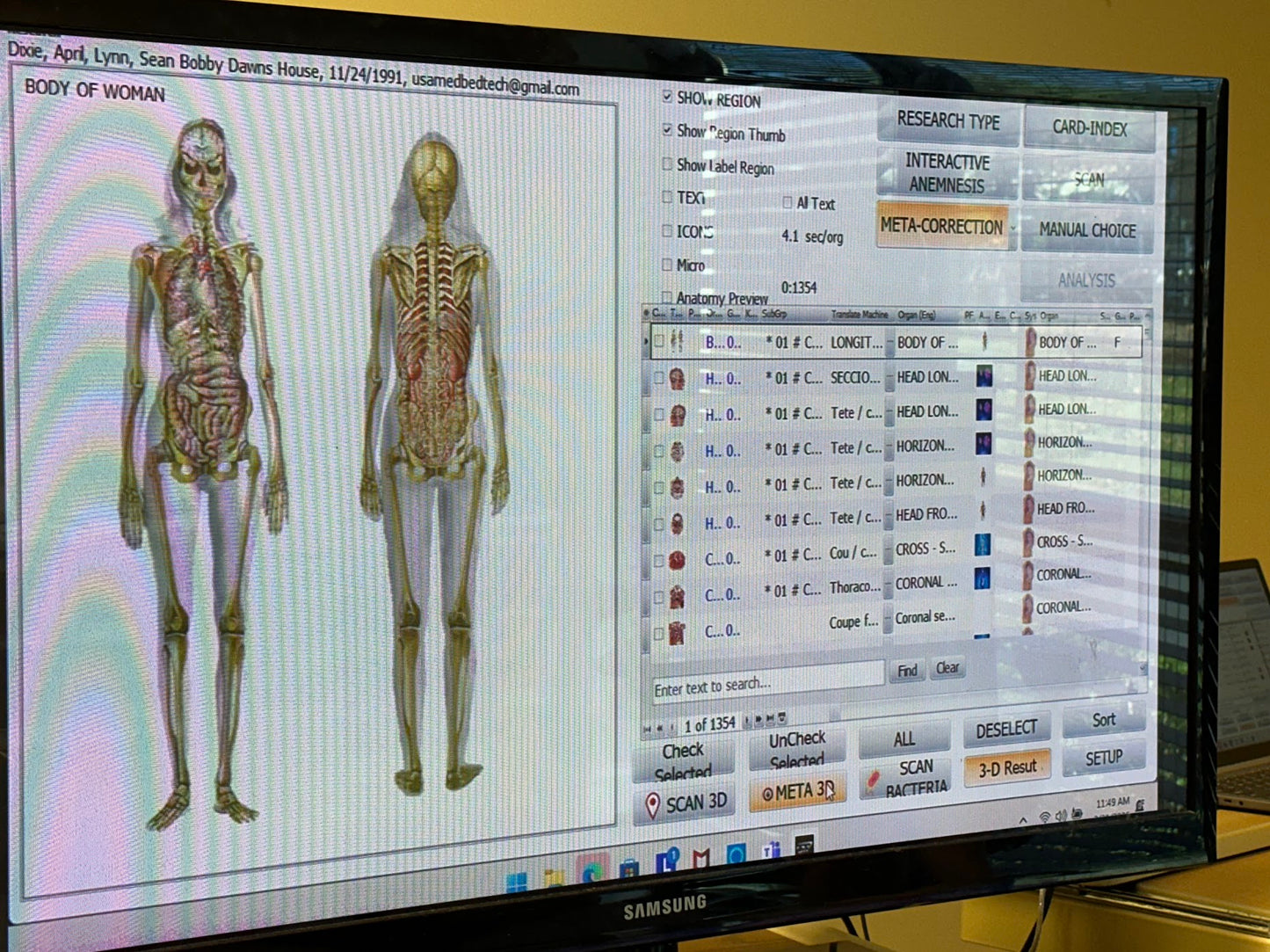 Computer screen displaying an anatomical skeleton model and software interface.