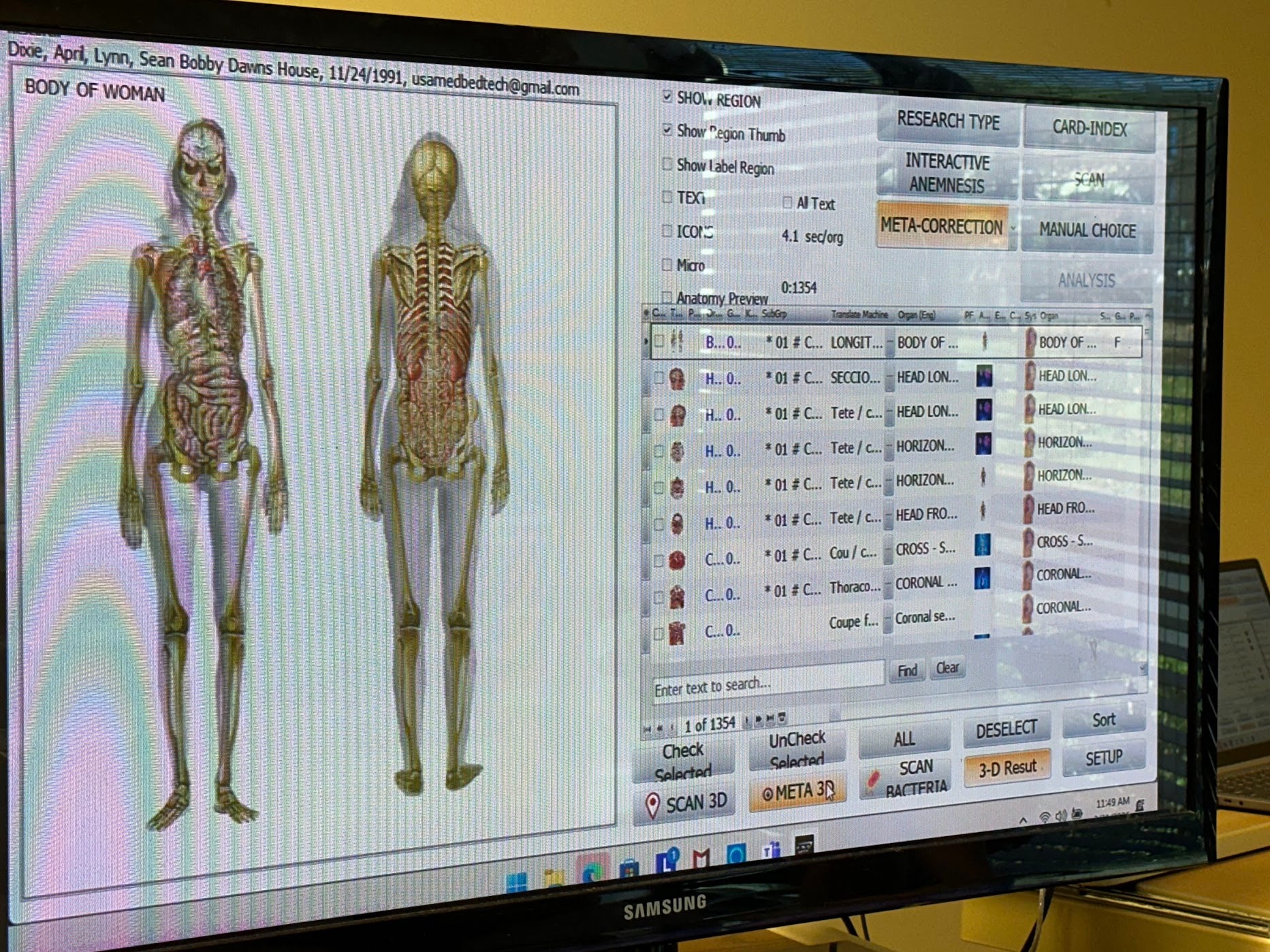 Computer screen displaying an anatomical skeleton model and software interface.