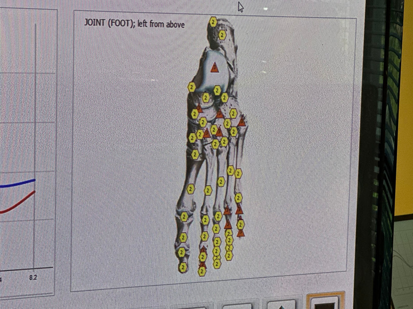 Diagram of a foot joint with labeled bones on a computer screen