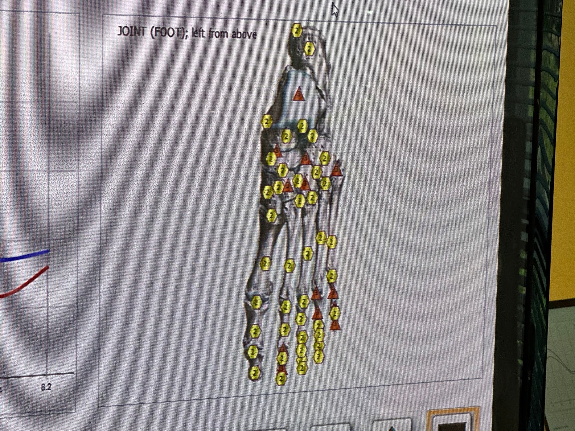 Diagram of a foot joint with labeled bones on a computer screen